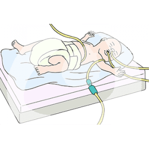 Ein Baby mit Schläuchen in Mund und Nasen liegt in Windeln auf einer Unterlage.