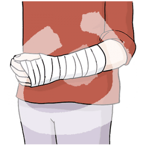 Ein verbundener Unterarm.