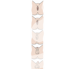 5 Varianten von Geschlechtsteilen: eindeutige Vagina, eindeutiger Penis und 3 uneindeutige Variationen