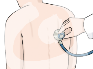 Eine Person mit nacktem Rücken. Eine Hand hält an den Rücken ein Stethoskop.