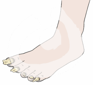 Nackter Fuß mit schlechten Nägeln. Nägel sind gelb und schmutzig. Sie sind verschieden lang und abgebrochen.