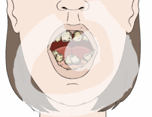 Halbes Gesicht von der Nase zum Kinn. Der Mund ist geöffnet. Man sieht schmutzige und schiefe Zähne. Einige fehlen.